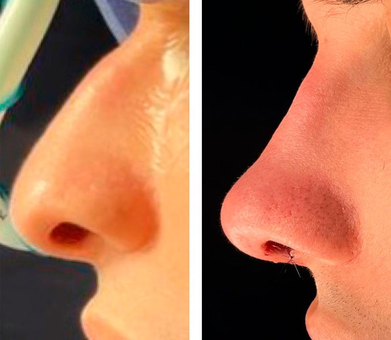 Antes e depois da rinoplastia